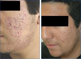 ... probably wish to discover the best acnes cars treatment that you can